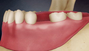 Digital illustration of a mouth missing a tooth