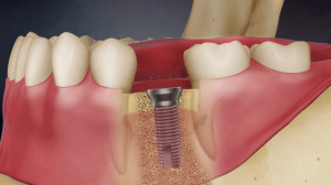 Digital illustration of a mouth with a placed dental implant