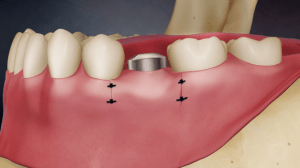 Digital illustration of a mouth with a placed dental implant