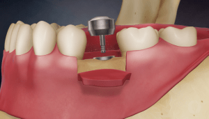 Digital illustration of a mouth with a placed dental implant