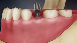 Digital illustration of a mouth with a placed dental implant