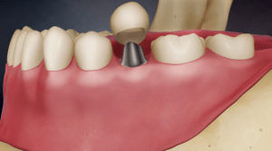 Digital illustration of a mouth with a crown being placed over a dental implant