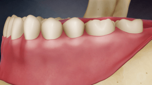 Digital illustration of a mouth with a crowned dental implant