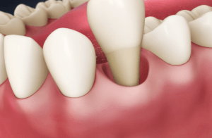 Digital illustration of a mouth with a tooth being extracted