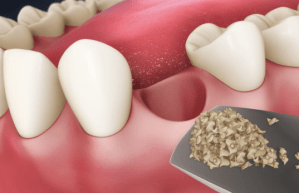 Digital illustration of a mouth with bone material being placed into the space of a recently extracted tooth