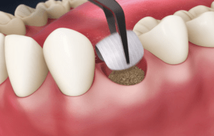 Digital illustration of a mouth with bone material being placed into the space of a recently extracted tooth