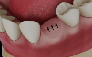 Digital illustration of a mouth after bone grafting in place of a missing tooth